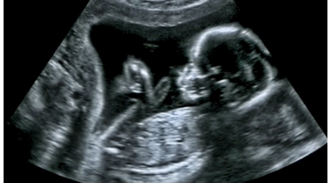 İnsan nesli tehlikede! "2045 yılında sperm sayısı "0" olacak" 